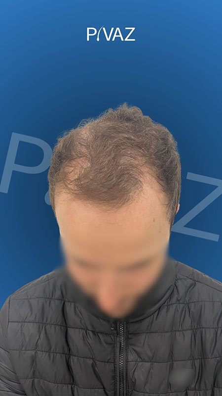 ANTES